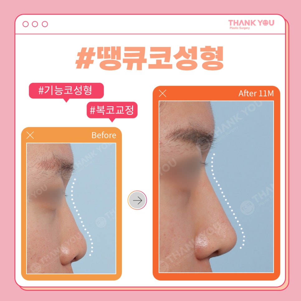 코성형 전후, 코모양 신논현역 성형외과에서 체크 관련 이미지 3