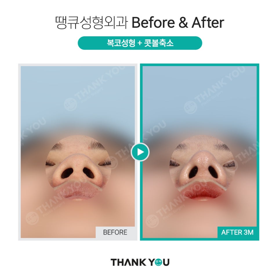 코 재수술시 기존 실리콘은 꼭 제거해야 되나요? 관련 이미지 11