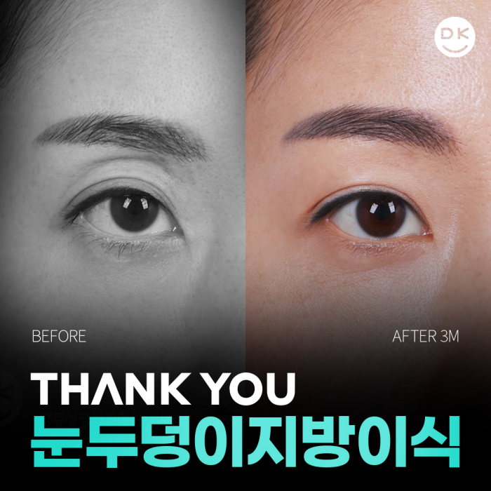 눈두덩이지방이식으로 피곤한 이미지 탈출! 생기있는 눈매 완성! 관련 이미지 1