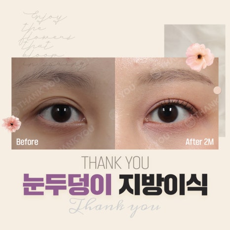 눈두덩이 지방이식, 푹꺼진 눈꺼풀에 자가지방이식으로 관련 이미지 2