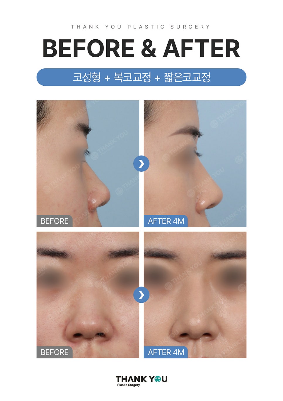 자가늑연골? 기증늑연골? 코성형수술 재료의 끝판왕? 관련 이미지 9