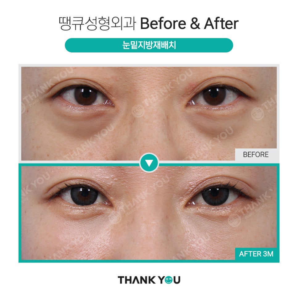 눈밑지 지방이식? 앞광대지방이식 필요한 이유? 관련 이미지 13