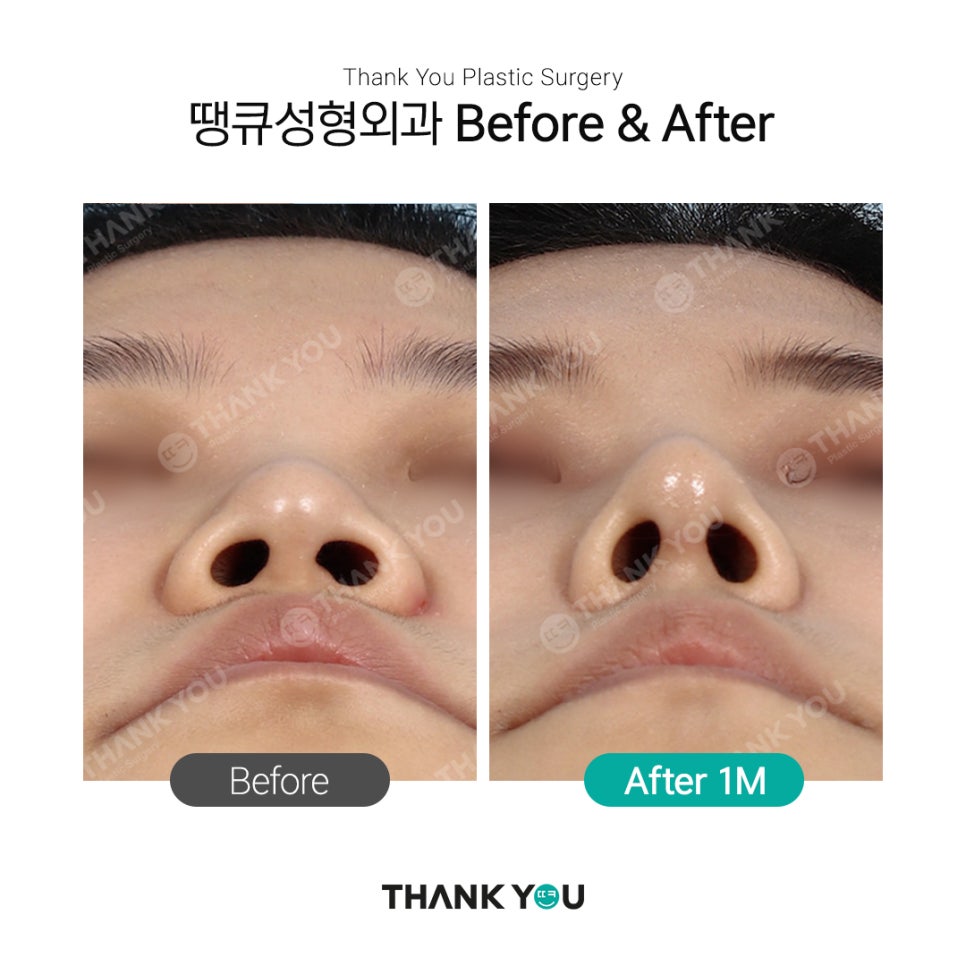 남자코성형 여자코성형 디자인 차이점 (코성형 전후) 관련 이미지 8