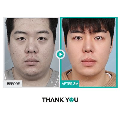 땡큐 맥미남, 뮤지컬배우 남자 복부지방흡입 전후 Check 관련 이미지 5