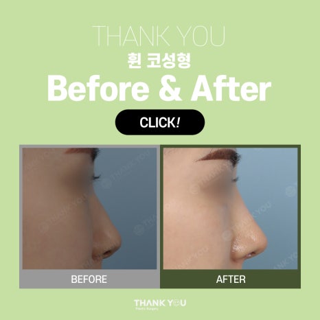 코수술, 모양에 따른 디자인이 중요 포인트 관련 이미지 8