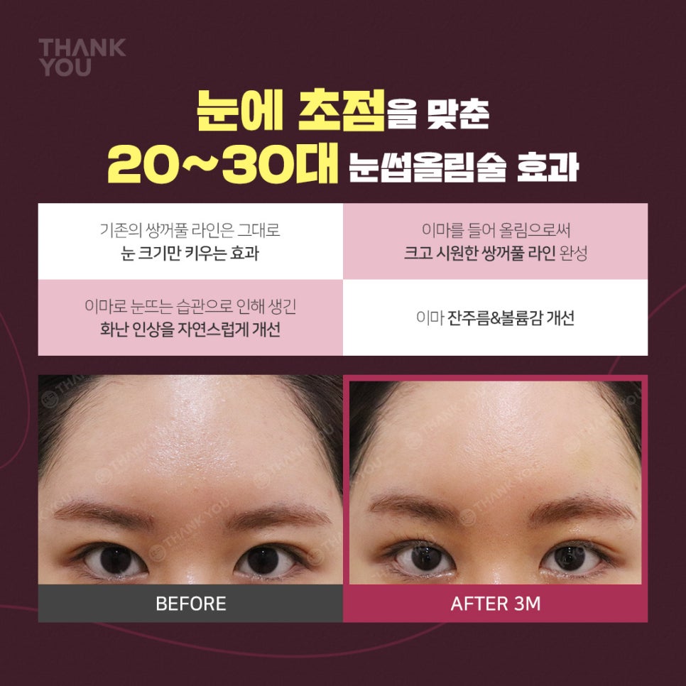 엔도타인 이마거상 찾는다면?시니어&주니어 눈썹올림술 관련 이미지 3