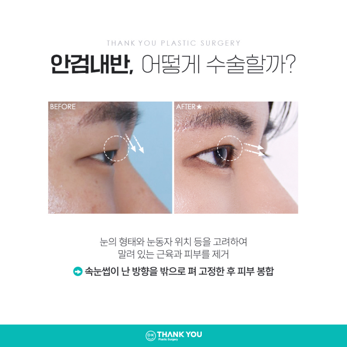 기능눈성형 근본적인 원인을 개선해야 해요! 관련 이미지 9