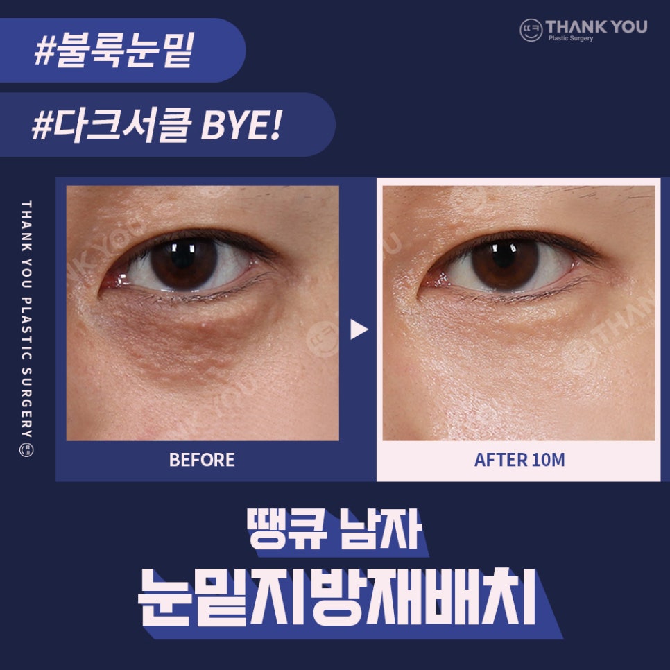 붐 눈밑지방재배치? 남자 눈밑지 전후 (붐, 남창희, 김동현) 관련 이미지 10