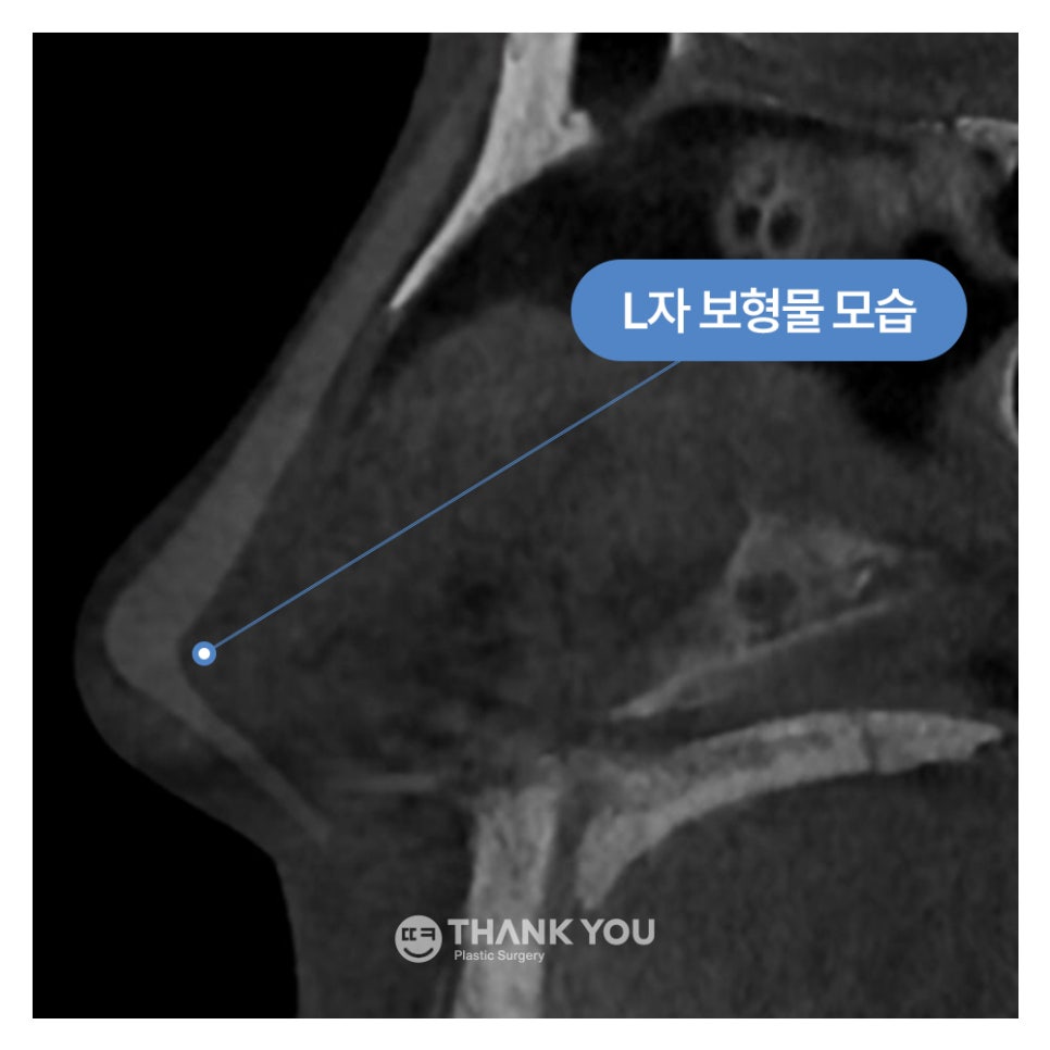 코성형 아직도 L자보형물? 실리콘 선택 기준은? 관련 이미지 2