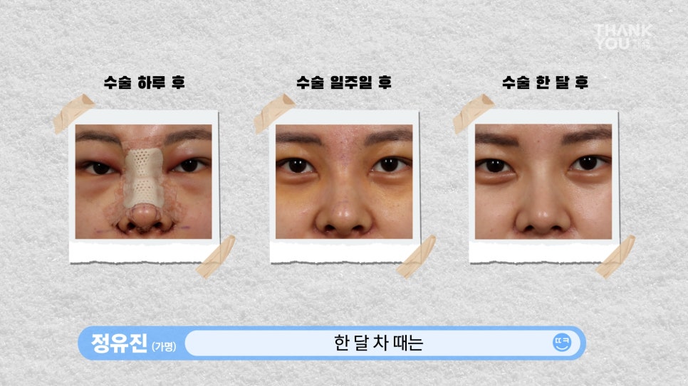 뚱뚱한 코 탈출! 실리콘 코성형👃(직원 코성형 브이로그2탄) 관련 이미지 14