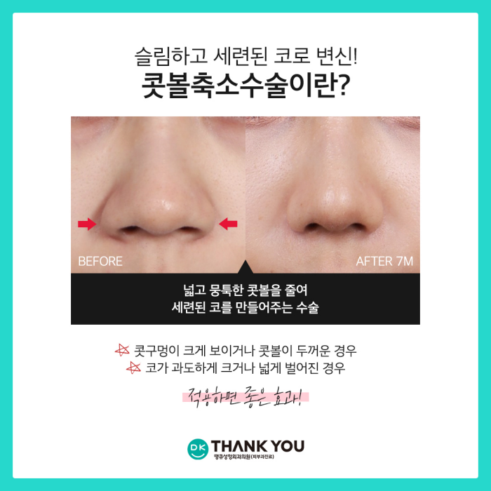 콧볼축소술효과로 세련된 이미지로의 변신 성공! 관련 이미지 2