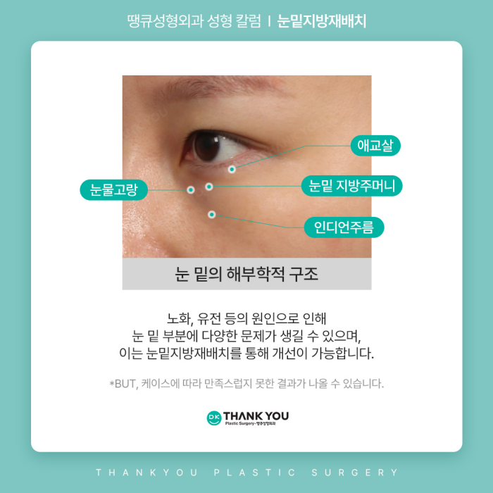 눈밑지방재배치수술만으로 볼륨이 부족하다면? 관련 이미지 3