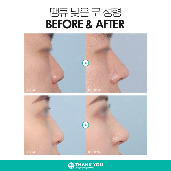 낮은코성형, 완성도 높은 결과를 얻고 싶다면 주목! 관련 이미지 8