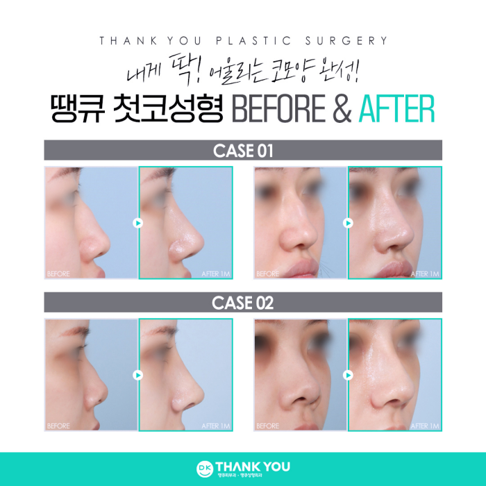 첫코성형은 코수술잘하는곳에서, 내게 딱 맞게! 관련 이미지 4