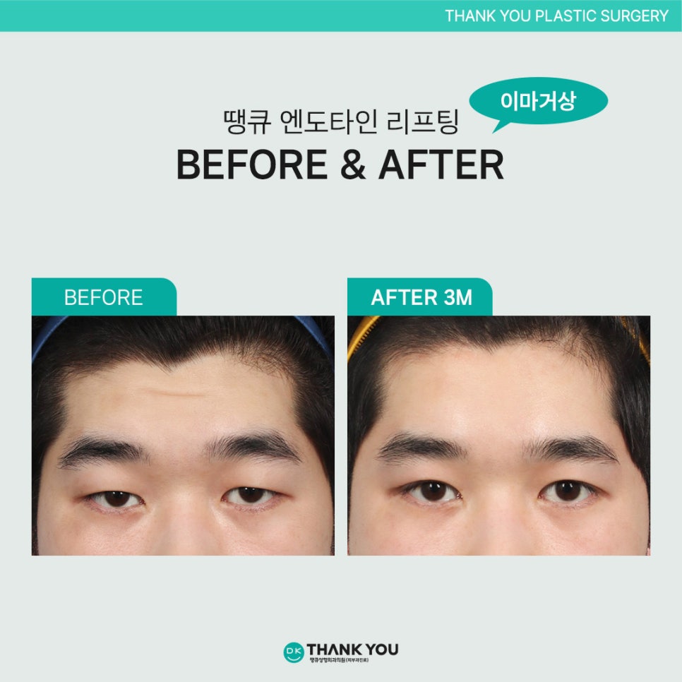 Endotine Lifting: If You Want Better Results?! image 13