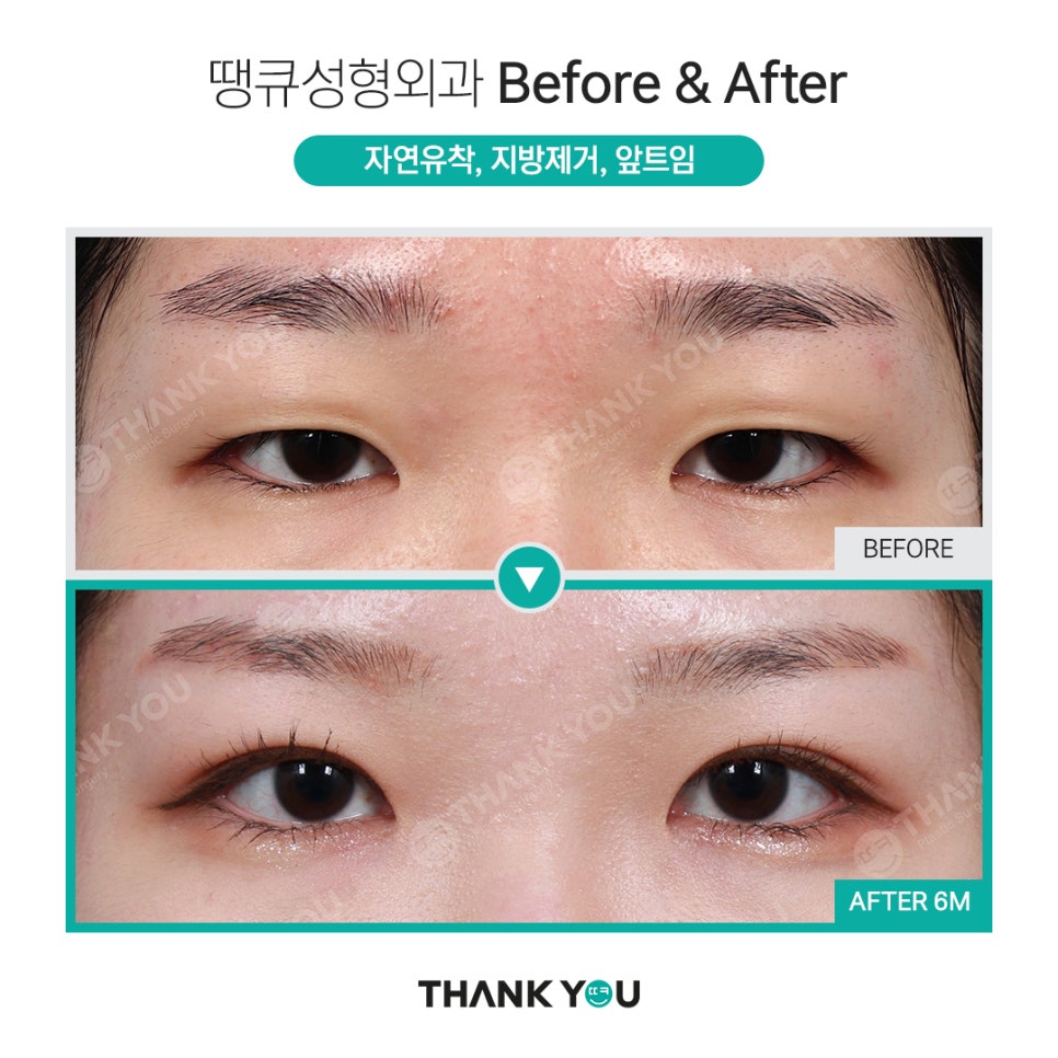 쌍수 뒷트임 (앞트임,밑트임, 듀얼트임 종류) 전후사진 관련 이미지 5