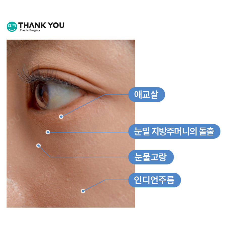 눈밑 불룩, 눈밑지 대신 눈밑지방제거만 단독으로? 관련 이미지 3