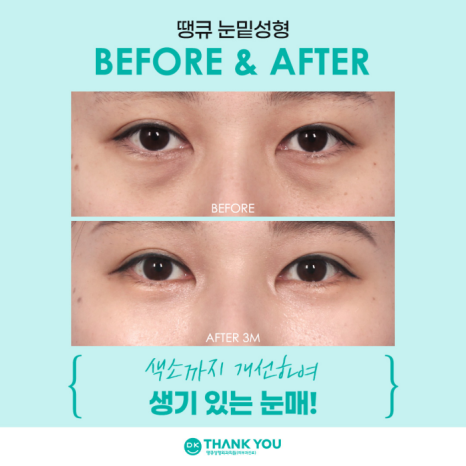 눈밑성형수술 만족도를 높이는 방법은? 관련 이미지 9