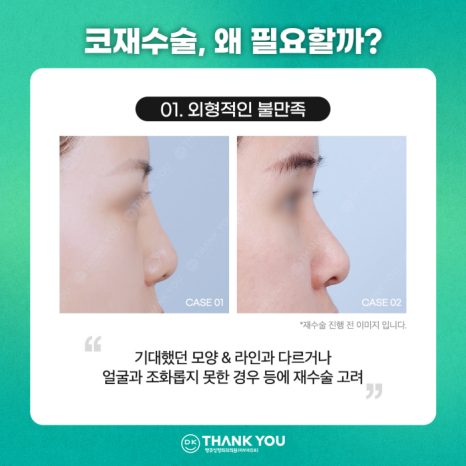 코재수술잘하는곳, 신중하게 선택해야 하는 이유는? 관련 이미지 2