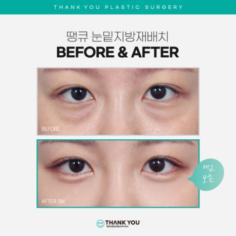 Recommended Under-Eye Fat Repositioning! Transform Your Look to Be Brighter and More Vibrant! image 9