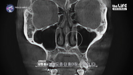 땡큐성형외과, 맥미걸 솔루션! 하비갑개수술 X 미용코, 기능&middot;미용 개선을 동시에! 관련 이미지 5