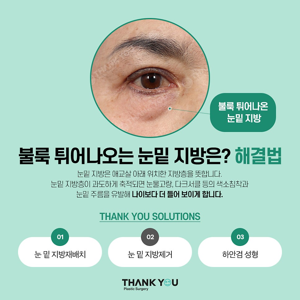 눈밑지 눈밑지방제거, 하안검 차이점은? (눈밑 비포&애프터) 관련 이미지 3