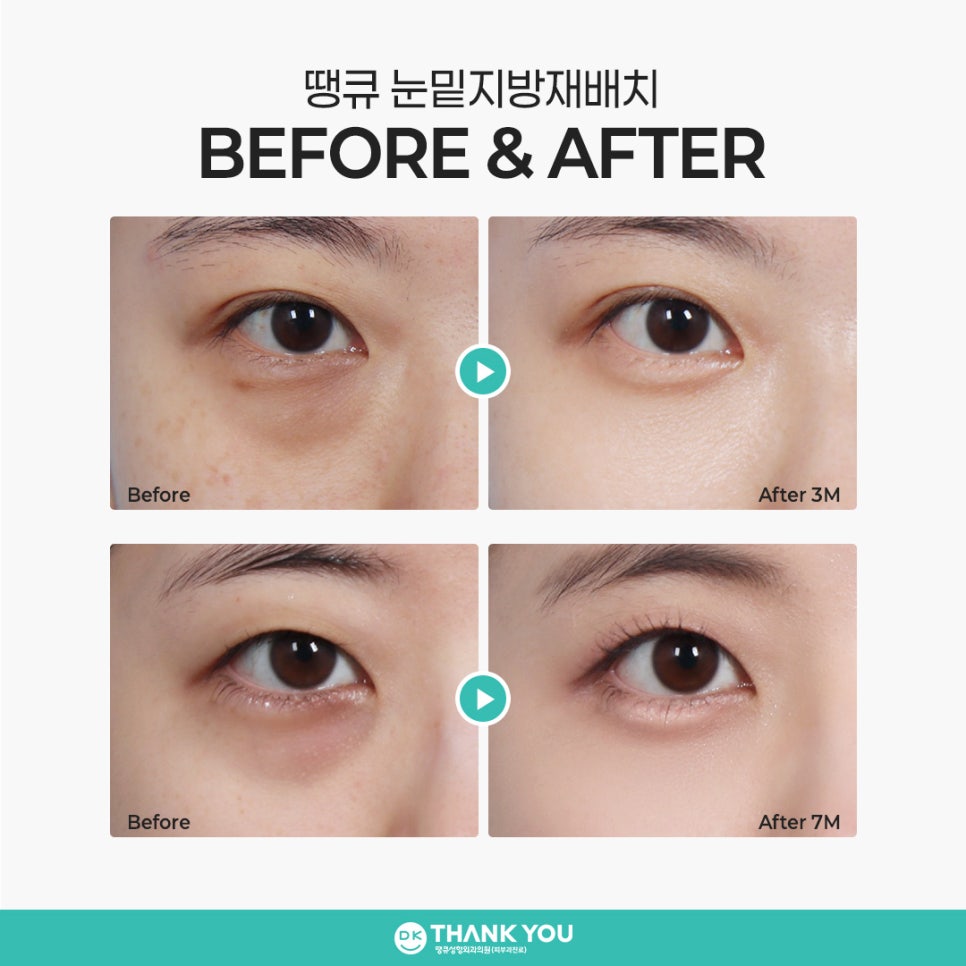 Choosing an Under-Eye Fat Repositioning Clinic: Want Natural, Long-Lasting Results? image 7