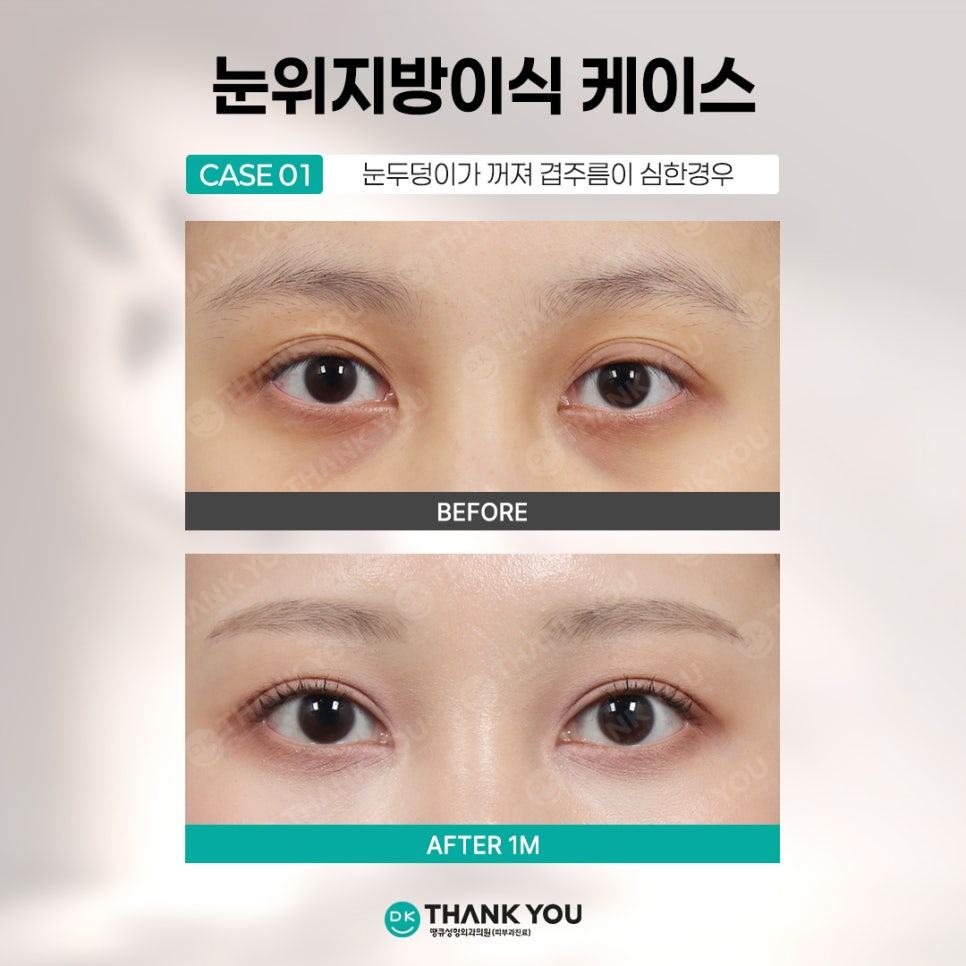 눈꺼풀꺼짐 개선하려면? 꺼진눈지방이식 전에 알아야 할 3가지 관련 이미지 10