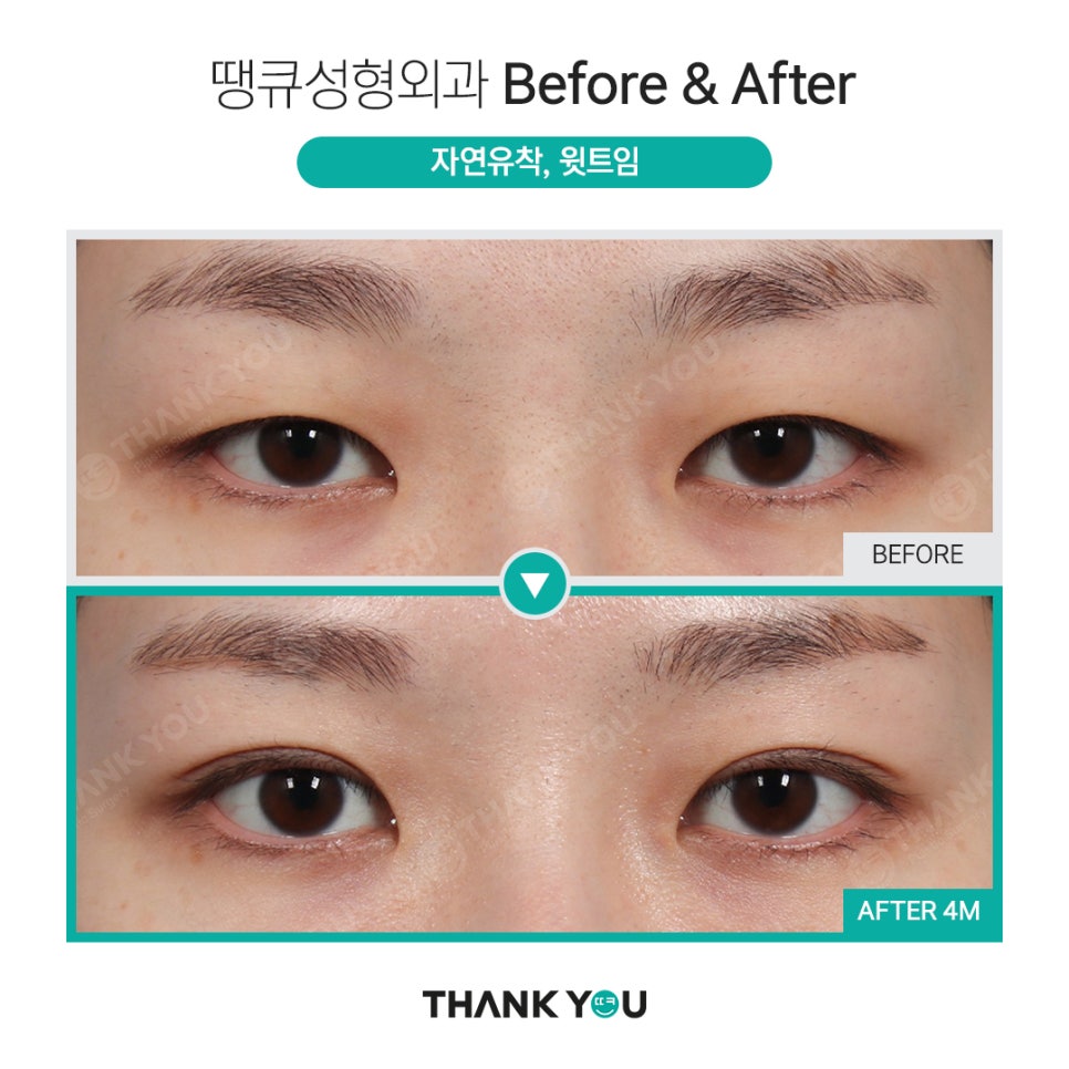 쌍수 뒷트임 (앞트임,밑트임, 듀얼트임 종류) 전후사진 관련 이미지 8