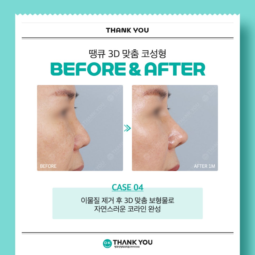 땡큐성형외과 권정우 원장, 해외 성형외과 학회서 코수술 강연 진행 (feat. 3D 맞춤 보형물) 관련 이미지 10