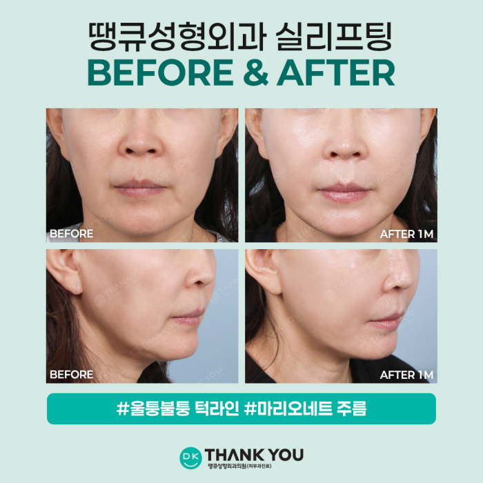 If You Want to Create a Noticeable Difference Before and After Face Thread Lifting image 6