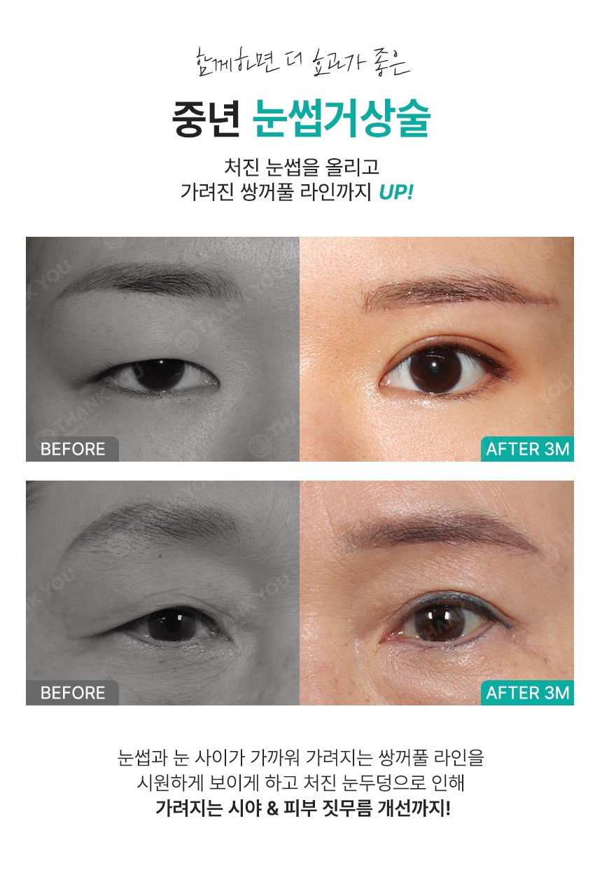 [의학칼럼]노화로 축 처진 눈꺼풀.. 동안 얼굴ㆍ눈 건강 되찾으려면? 관련 이미지 4