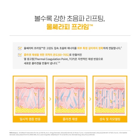 피부층을 정밀관찰하며 리프팅 울쎄라피 프라임 ULTHERA — JM’s Devices 관련 이미지 6
