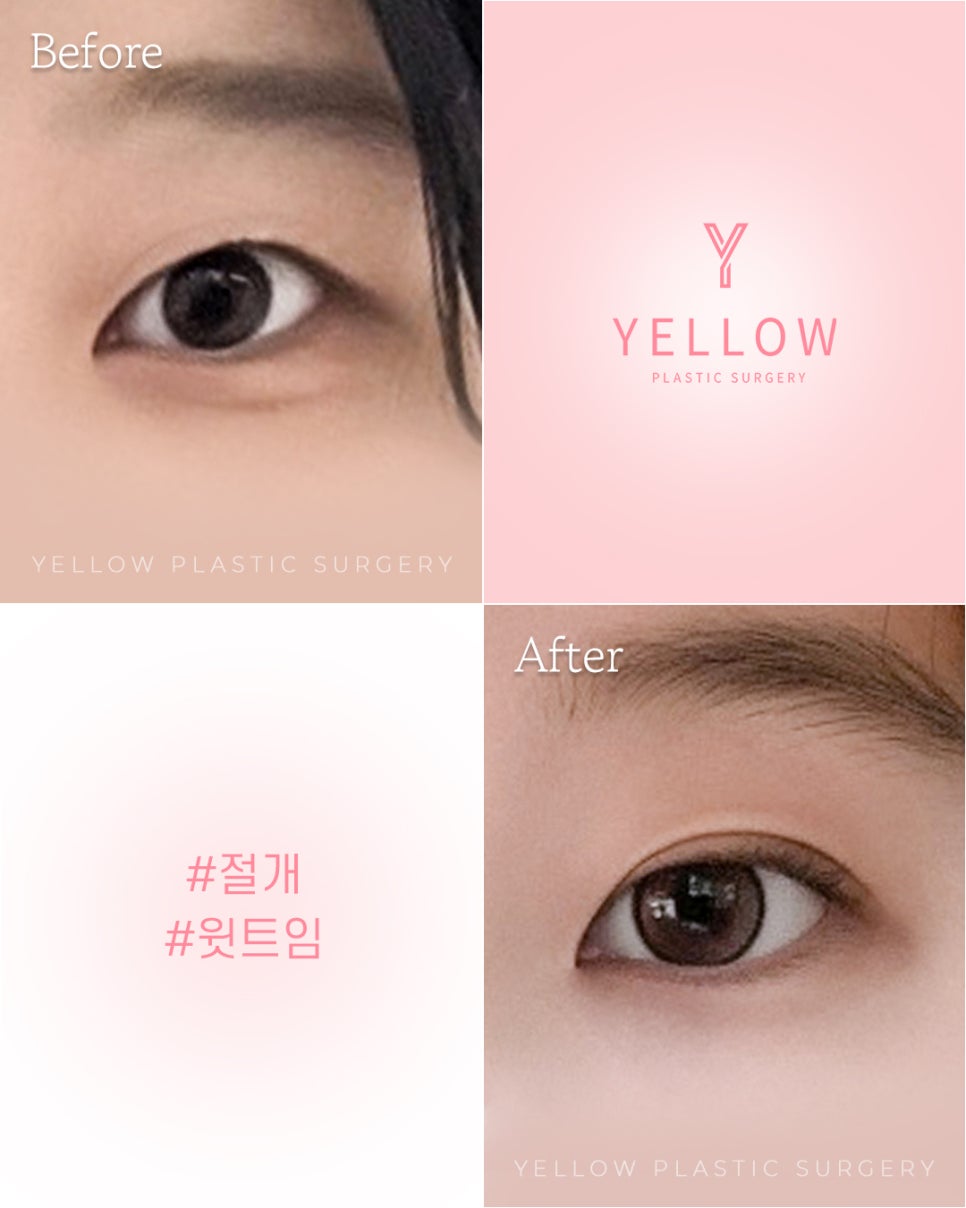 [ Gangnam Station Yellow Plastic Surgery / Eye Surgery ] Incision + Upper Epicanthoplasty image 1