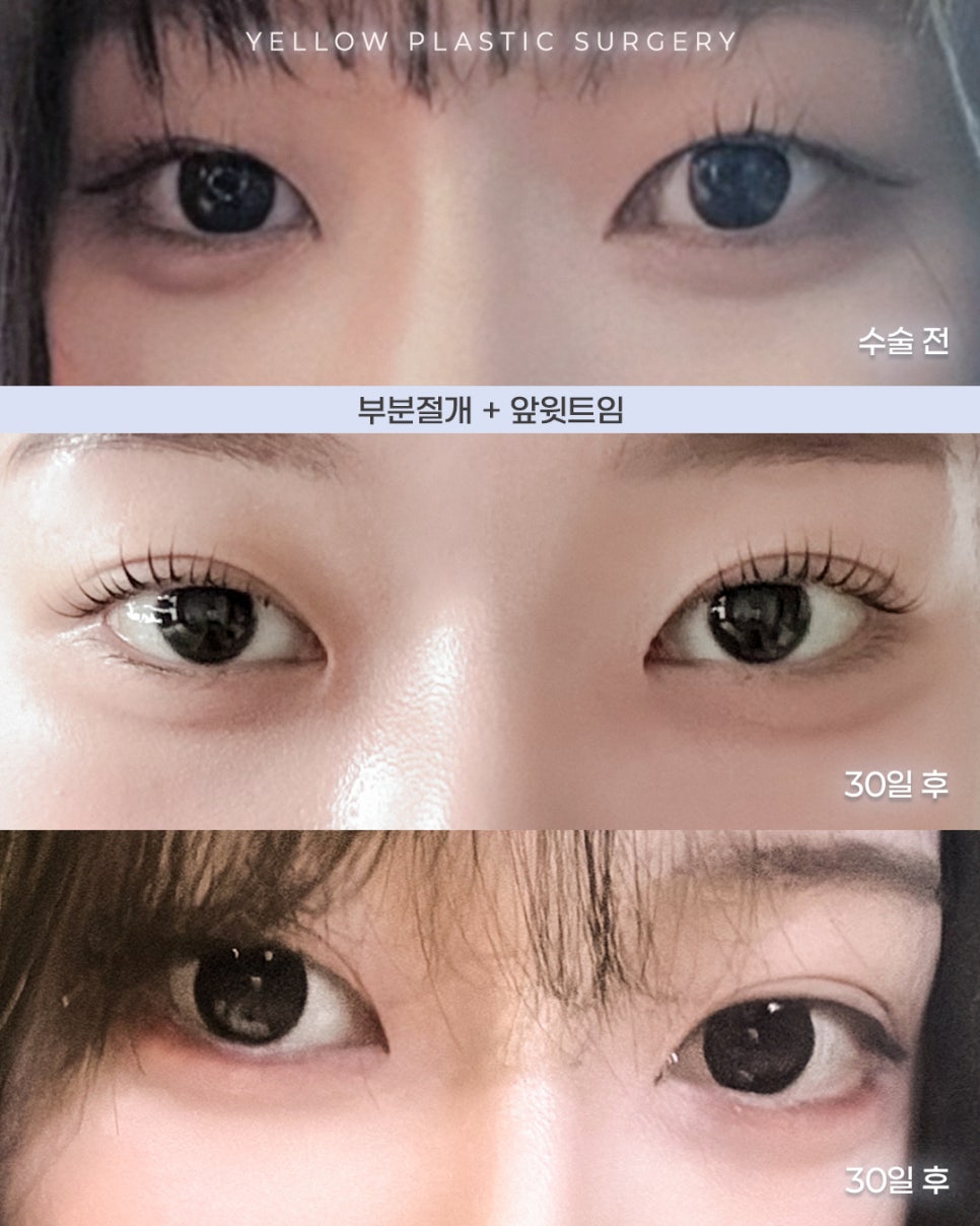[ 강남역 옐로우성형외과 / 눈성형 ] 부분절개 + 앞윗트임 관련 이미지 1