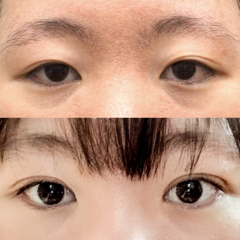 [ 강남역 옐로우성형외과 / 눈성형 ]  부분절개 앞트임 윗트임 수술 후기 2개월차 4개월차 관련 이미지 1