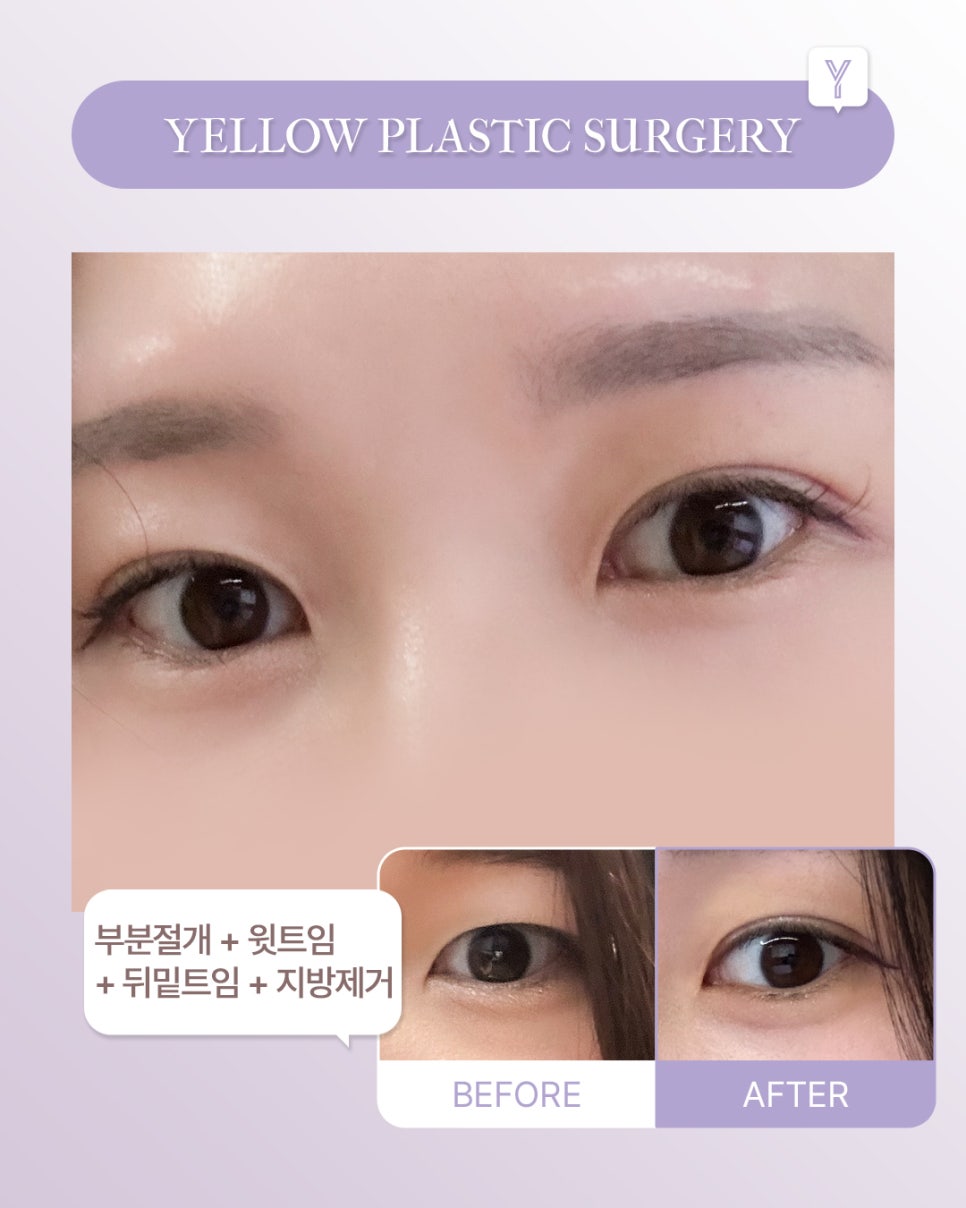 [ Gangnam Station Yellow Plastic Surgery / Eye Surgery ] Partial Incision + Upper Canthoplasty + Lateral and Lower Canthoplasty + Fat Removal image 1