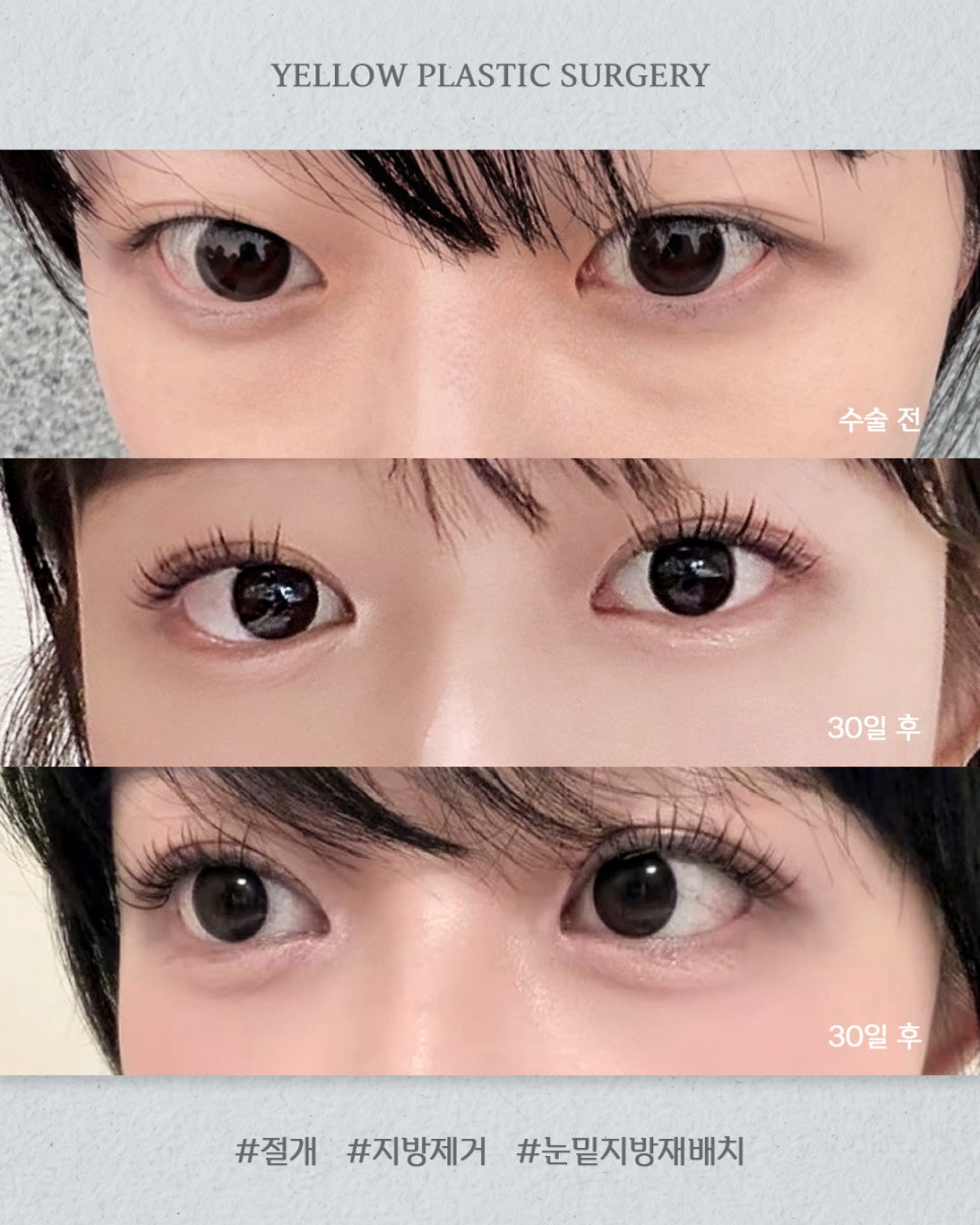[ 강남역 옐로우성형외과 / 눈성형 ] 절개 + 지방제거 + 눈밑지방재배치 관련 이미지 1