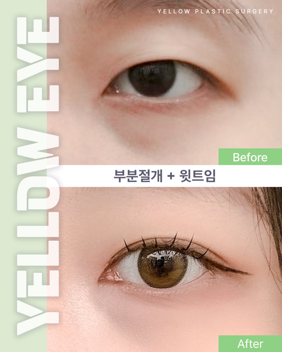 [ 강남역 옐로우성형외과 / 눈성형 ] 부분절개 + 윗트임 관련 이미지 1