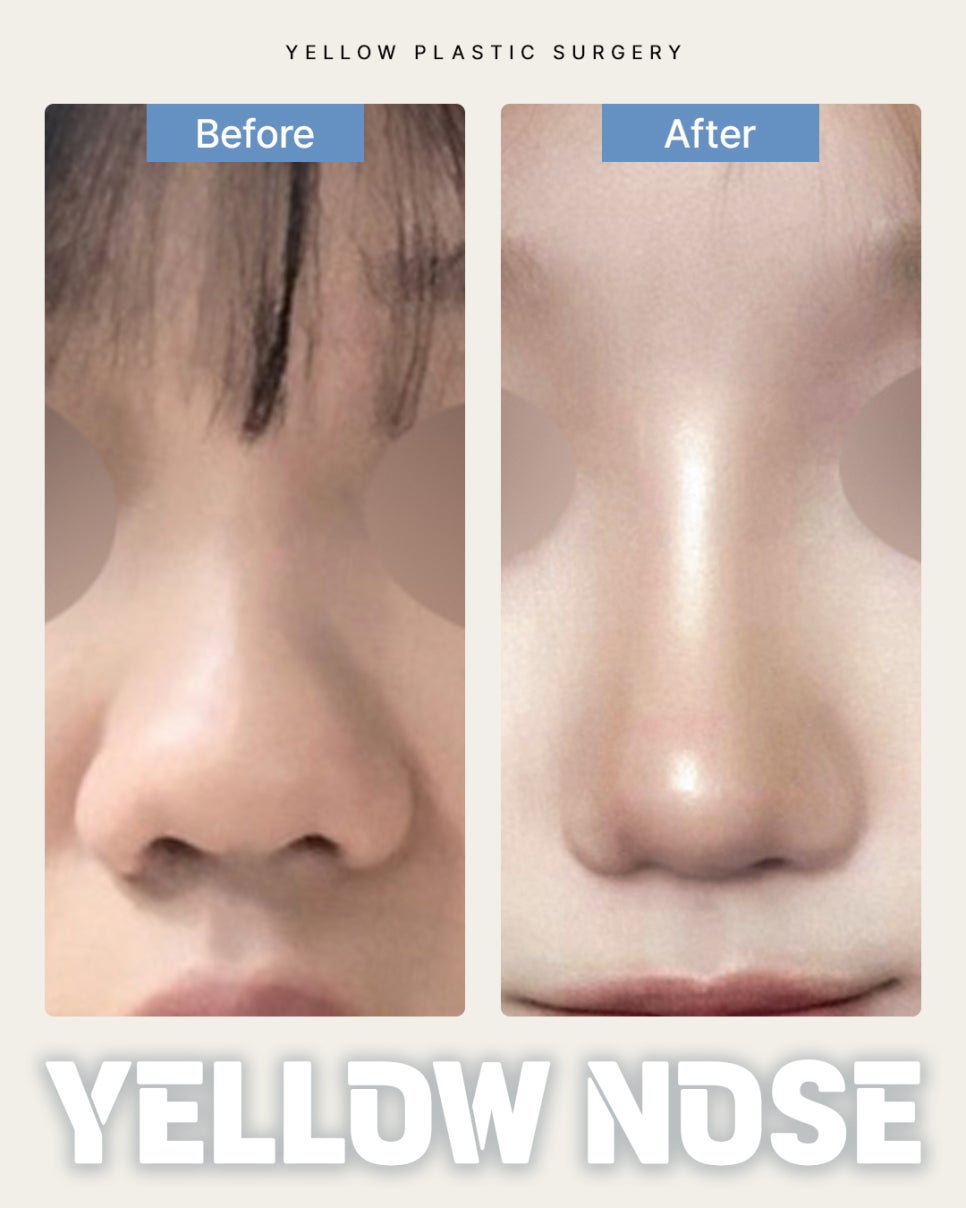 Gangnam Station Yellow Plastic Surgery / Rhinoplasty image 1
