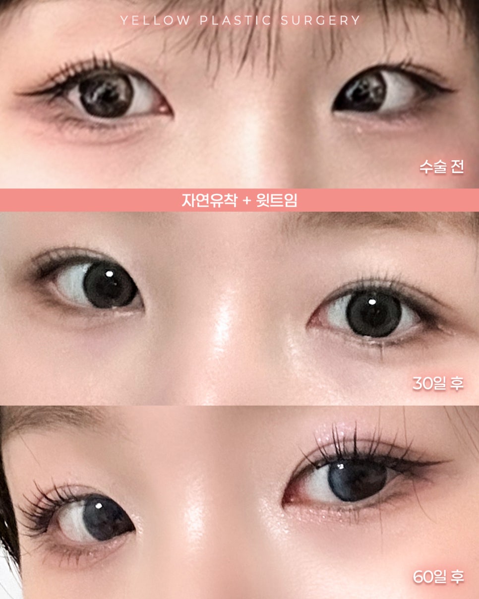 [ Gangnam Station Yellow Plastic Surgery / Eye Plastic Surgery ] Natural Adhesion + Upper Eyelid Opening image 1