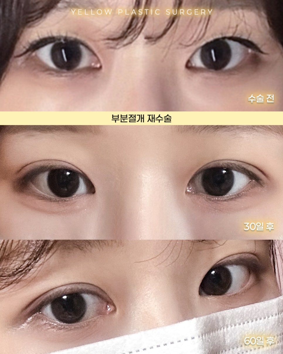 [ Gangnam Station Yellow Plastic Surgery / Eye Surgery ] Partial Incision Revision Surgery image 1