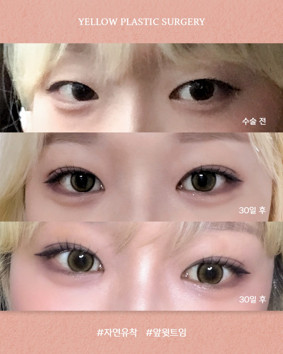 [ 강남역 옐로우성형외과 / 눈성형 ] 자연유착 + 앞윗트임 관련 이미지 1