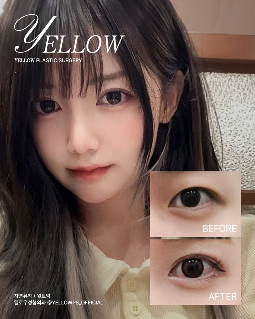 [ Gangnam Station Yellow Plastic Surgery / Eye Surgery ] Natural Adhesion + Upper Eyeline Incision image 1