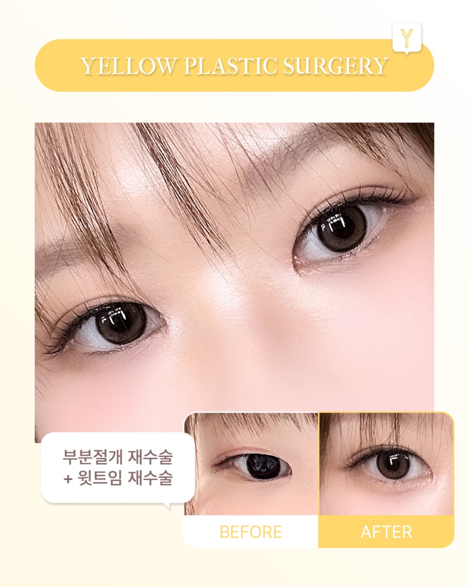 [ Gangnam Station Yellow Plastic Surgery / Eye Surgery ] Revision Surgery with Partial Incision + Revision Upper Epicanthoplasty image 1