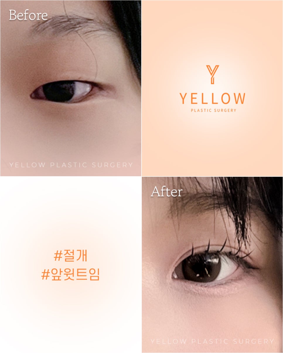 [ Gangnam Station Yellow Plastic Surgery / Eye Surgery ] Incision + Medial Epicanthoplasty image 1
