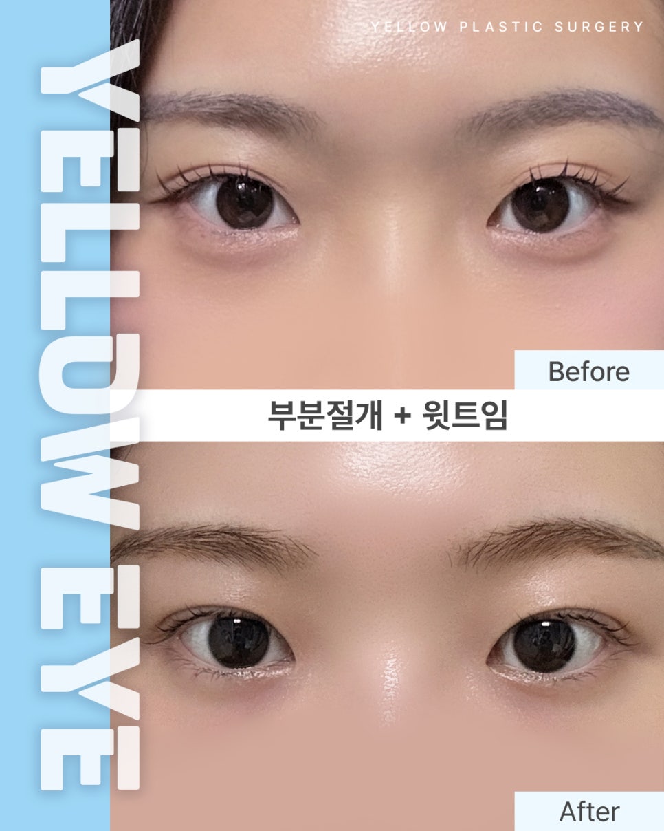 [ Gangnam Station Yellow Plastic Surgery / Eye Surgery ] Partial Incision + Upper Epicanthoplasty image 1