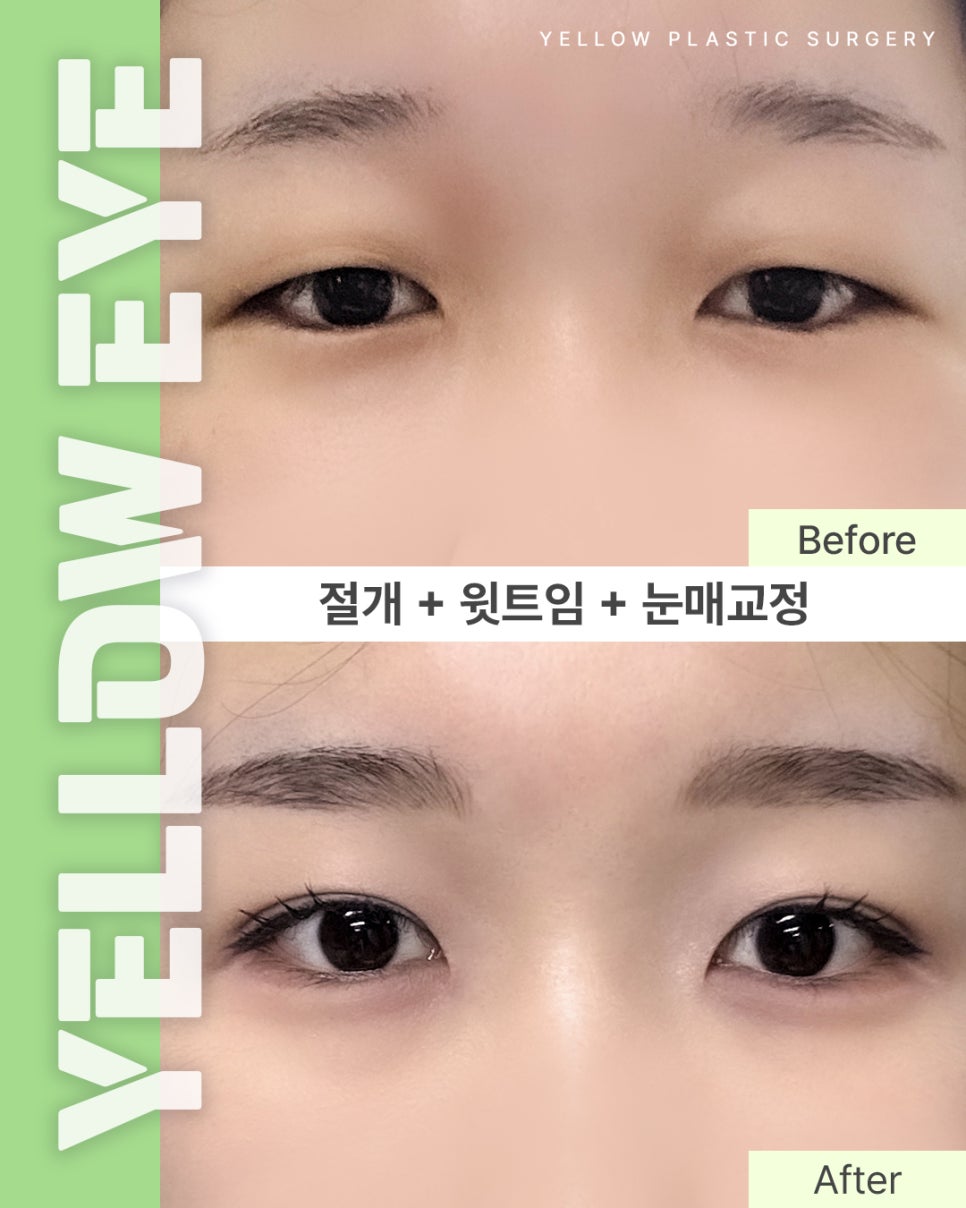 [ Gangnam Station Yellow Plastic Surgery / Eye Surgery ] Incision + Upper Epicanthoplasty + Ptosis Correction image 1