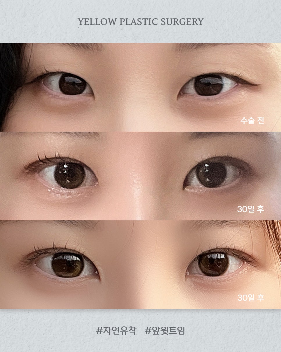 [ 강남역 옐로우성형외과 / 눈성형 ] 자연유착 + 앞윗트임 관련 이미지 1