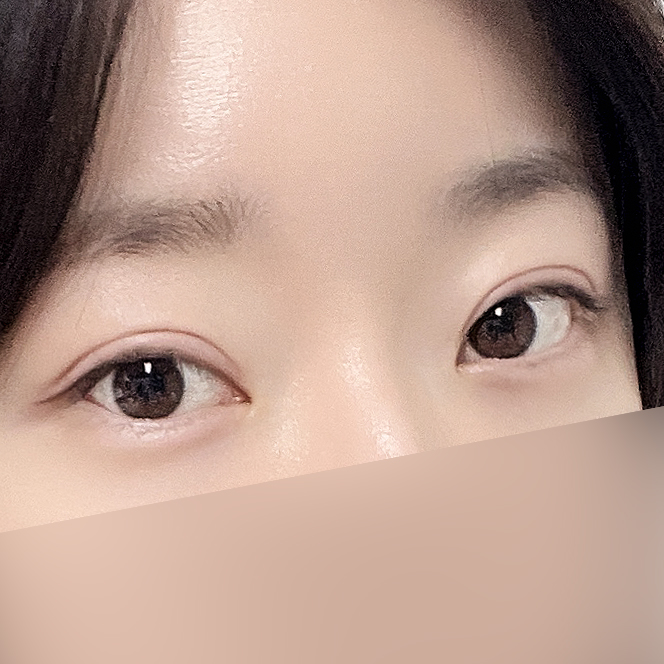 [Gangnam Station Yellow Plastic Surgery / Eye Surgery] Seven-Month Review After First Partial Incision Surgery: Improvement in Uneven Eyes image 8